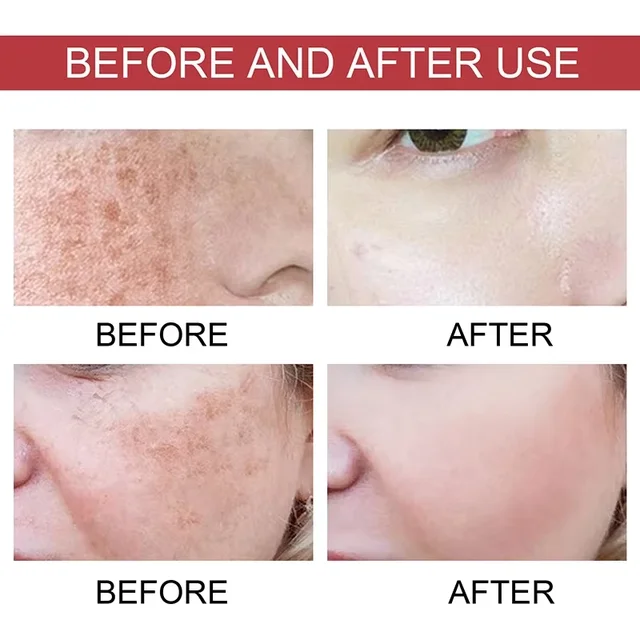 Niacinamide-Sérum anti-taches foncées pour le visage, correction de taches de rousseur, hydratant, éclaircissant, anti-pigmentation, réparation de la peau, soins de la mélanine – Image 3