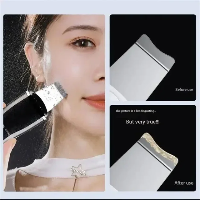 Dissolvant de points noirs, nettoyage des points noirs, dispositif de beauté pour rétrécissement des pores, peau morte, détartreur d'acné, nettoyant pour pores du visage, équipement de beauté – Image 5